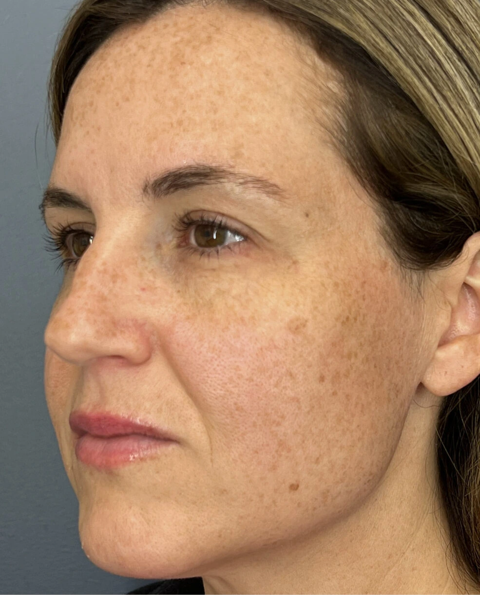 Face RF, illustrative before example