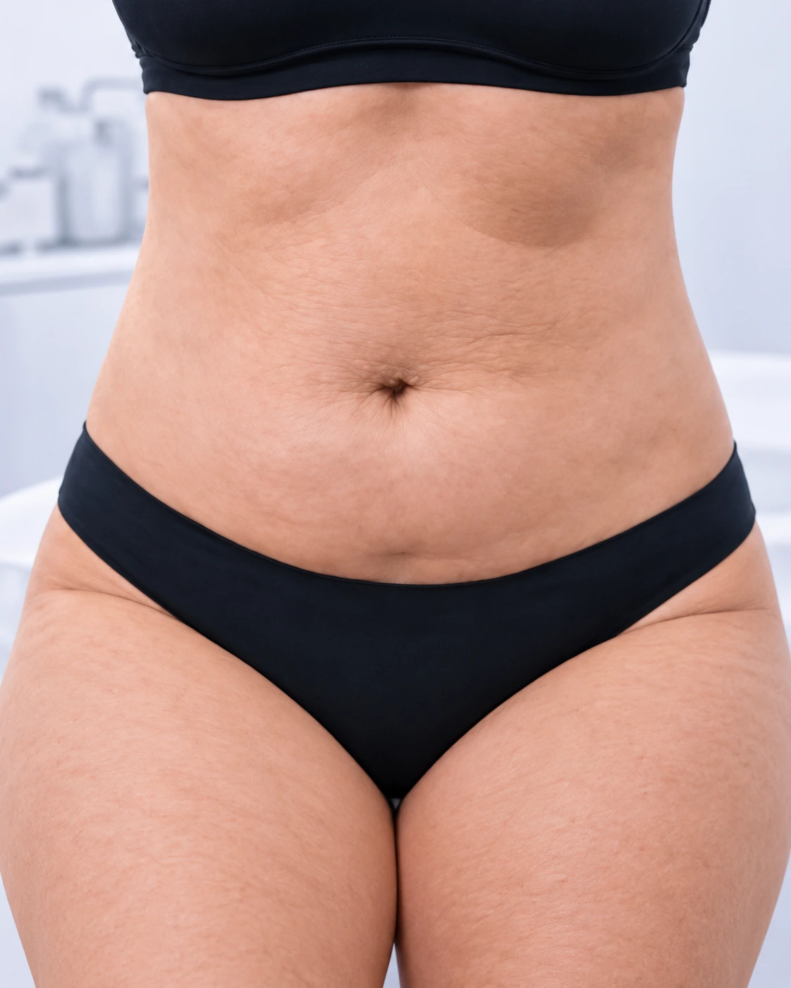 HIFU for Abdomen Reduction, illustrative before example