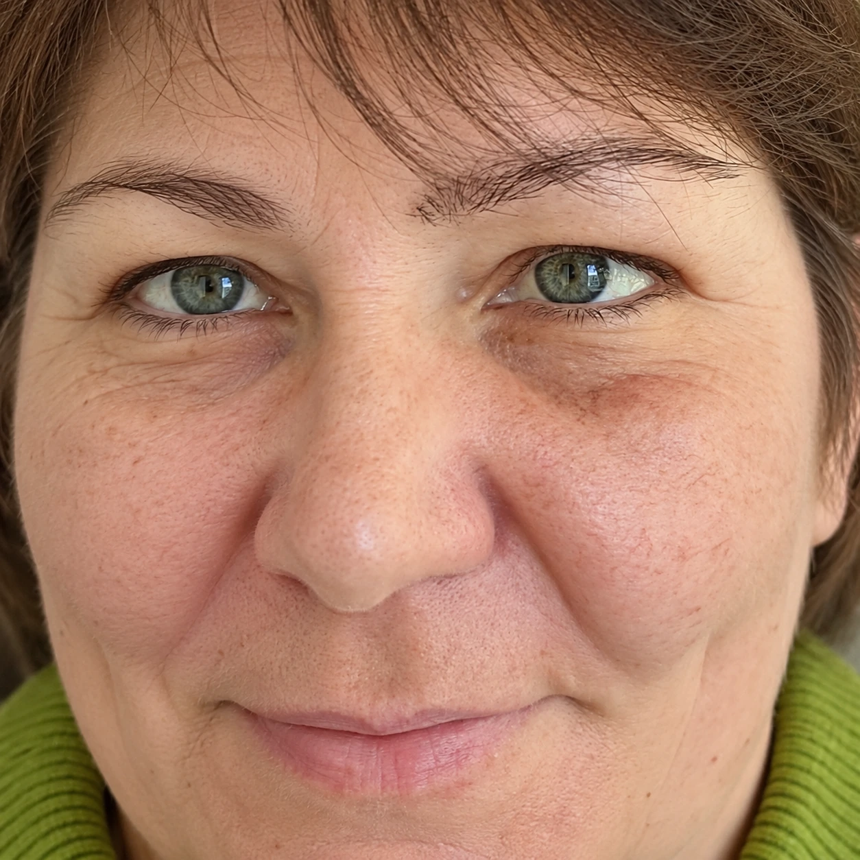 HIFU for Double-Chin Reduction, illustrative before example