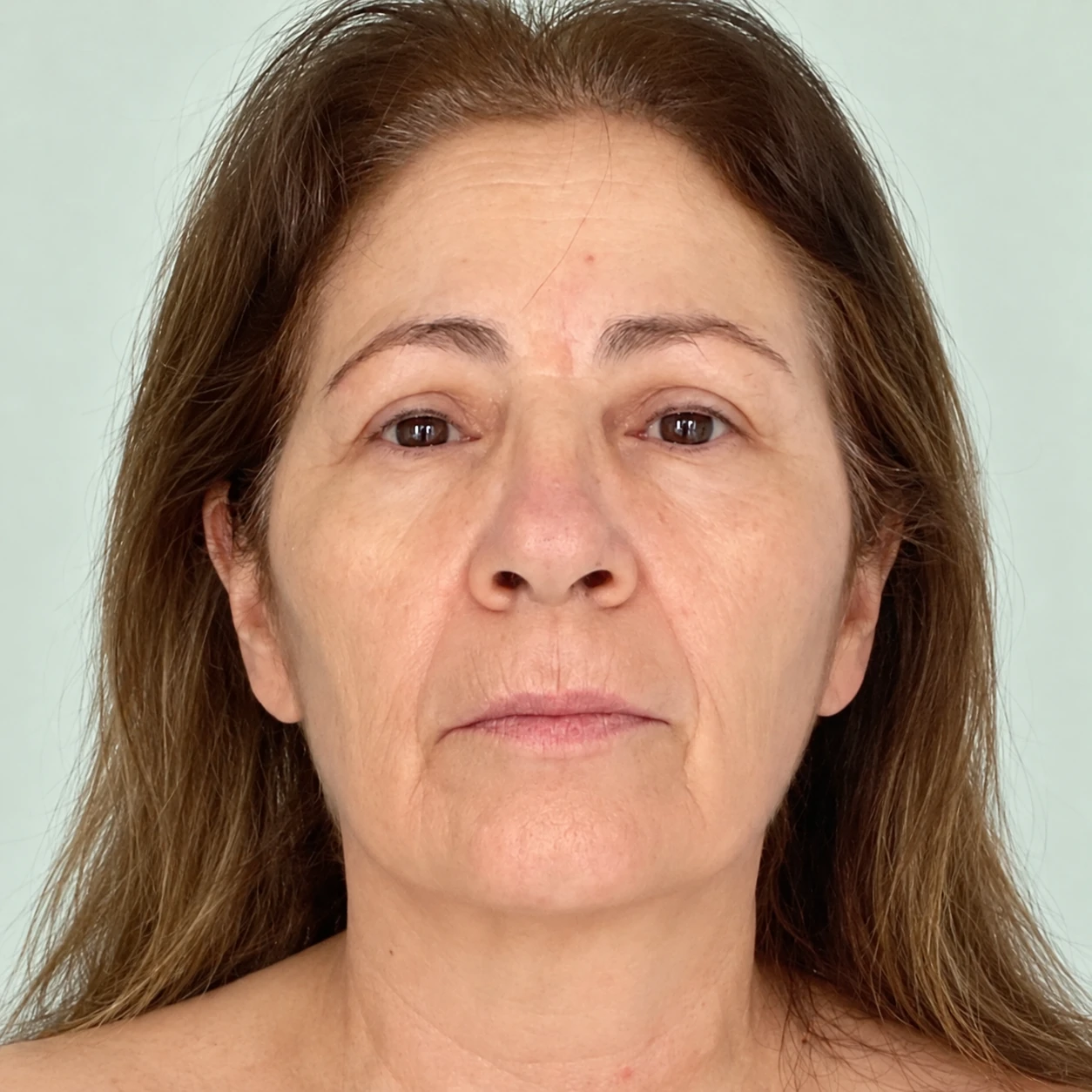 HIFU Non-Surgical Facelift, illustrative after example
