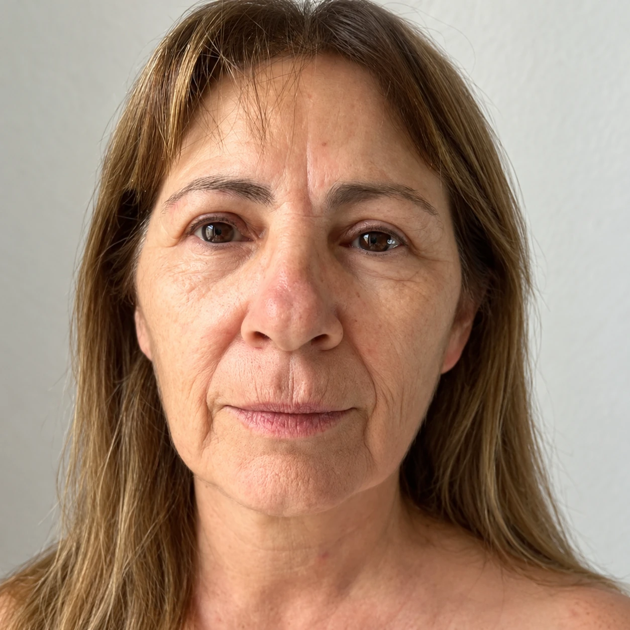 HIFU Non-Surgical Facelift, illustrative before example