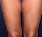 HIFU for Thigh Reduction, illustrative after example