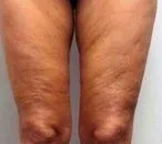 HIFU for Thigh Reduction, illustrative before example