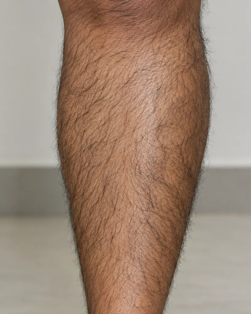 Laser Hair Reduction (LHR) using Triple-Wave Laser, illustrative before example