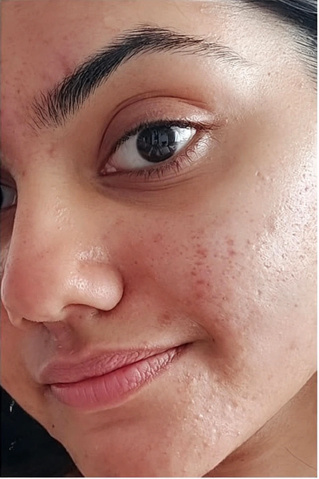 Power Hyaluronic Facial, illustrative after example