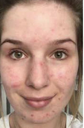 Power Oxygen Facial, illustrative before example