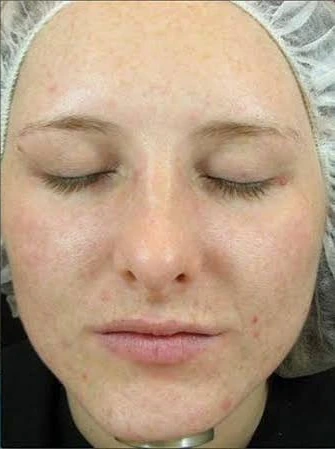 Pumpkin Peel Medi-Facial, illustrative after example