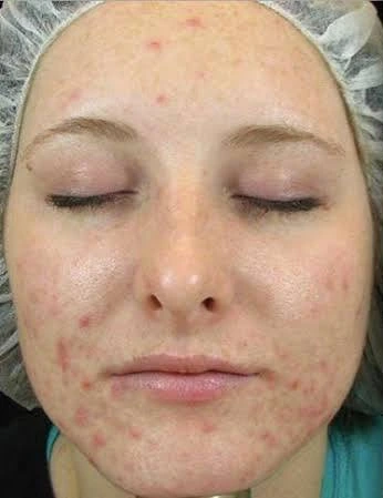 Pumpkin Peel Medi-Facial, illustrative before example