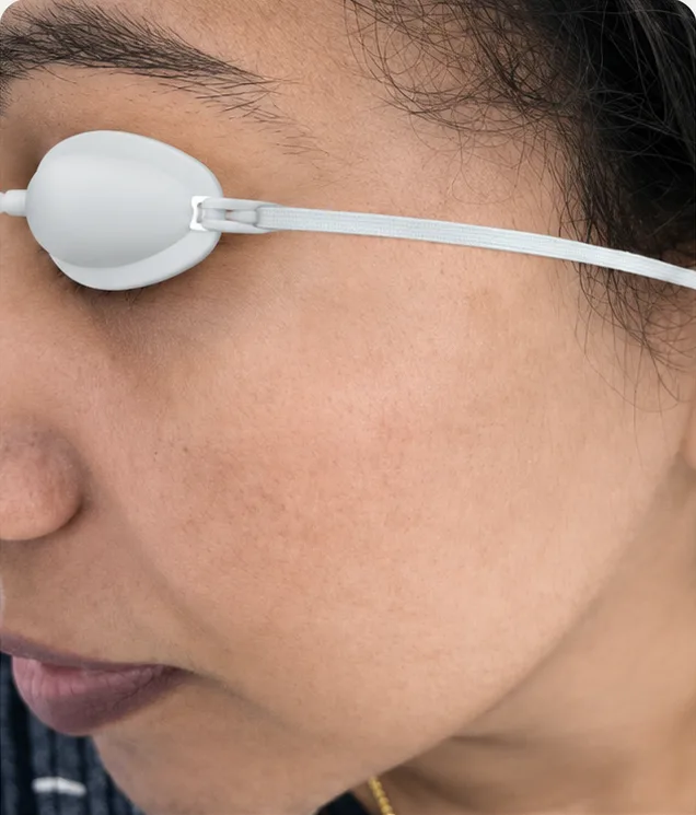 Cosmelan Peel — after treatment