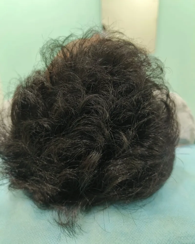 GFC Treatment for Hair — after treatment