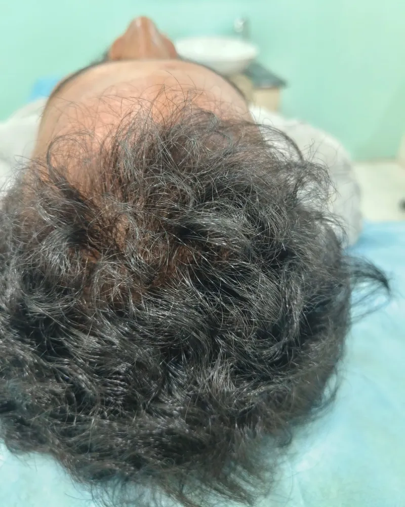 GFC Treatment for Hair — before treatment