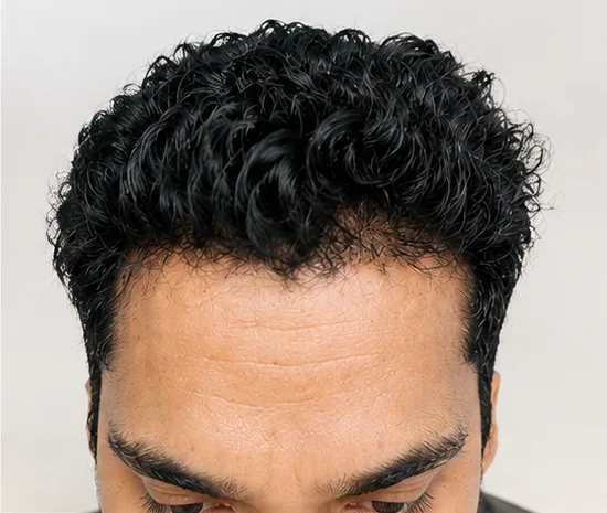 Hair Transplantation — after treatment