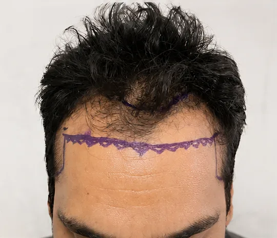 Hair Transplantation — before treatment