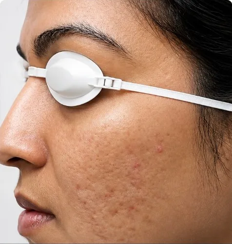 MNRF (Microneedling Radiofrequency) — before treatment